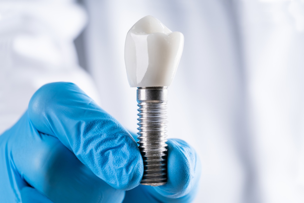 What Are Dental Implants?